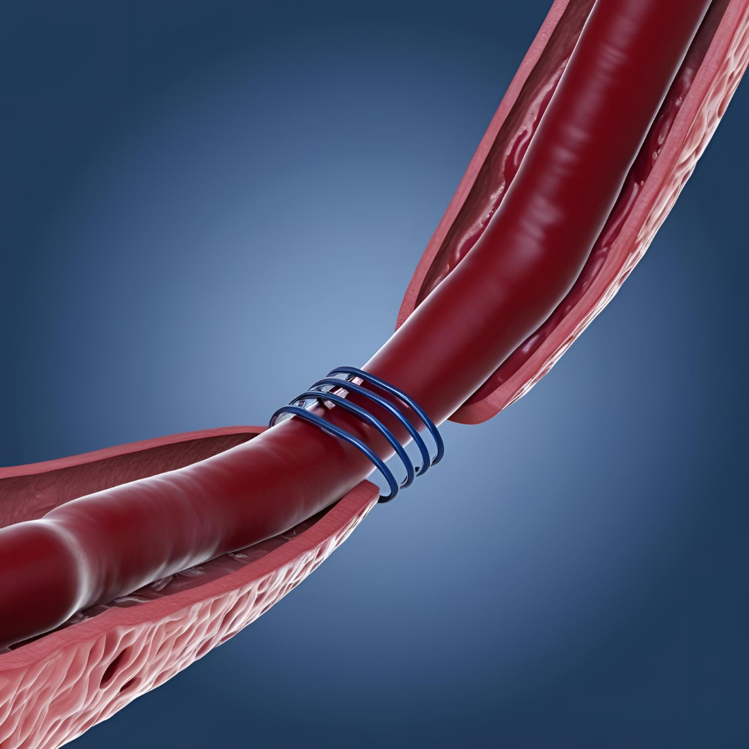 Endovascular